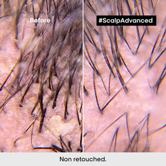 Scalp Advanced Anti-Dandruff Shampoo 300